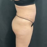 Abdominoplasty Before & After Patient #1378