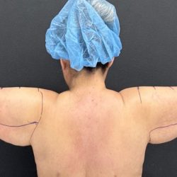Arm Lift Before & After Patient #1449
