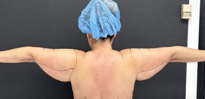 Arm Lift Before & After Patient #1449