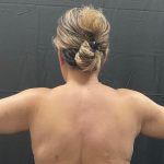 Arm Lift Before & After Patient #1449