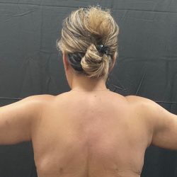 Arm Lift Before & After Patient #1449