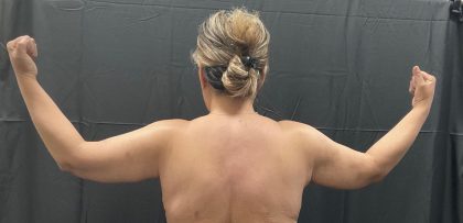 Arm Lift Before & After Patient #1449