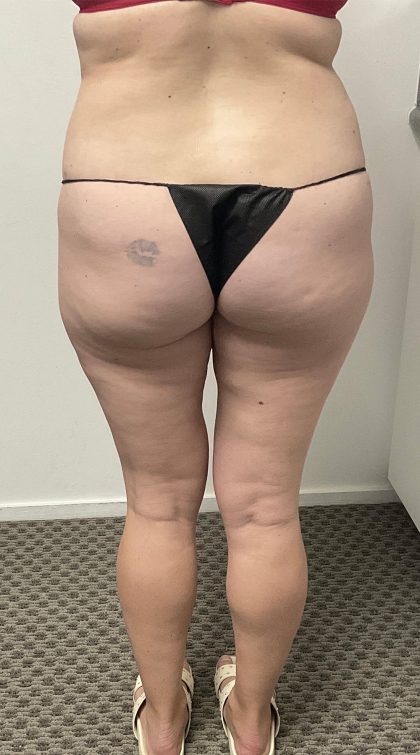 Lipedema Liposuction (Posterior Legs) Before & After Patient #1412
