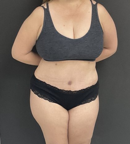 Mommy Makeover Before & After Patient #1404