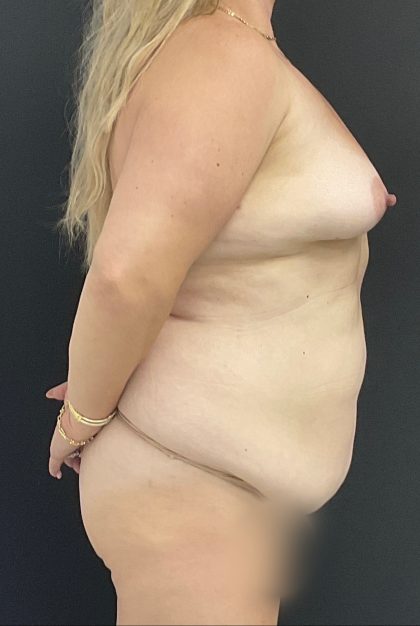 Mommy Makeover Before & After Patient #1431
